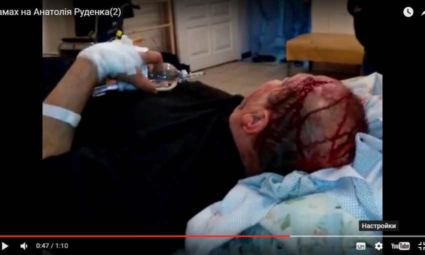 У избитого криворожского журналиста диагностировали открытую ЧМТ