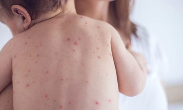 В Україні фіксують вроджений кір у немовлят